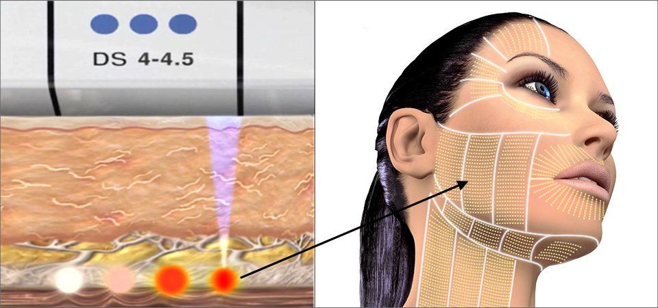 hình cô gái và máy ultherapy đang phát ra sóng siêu âm