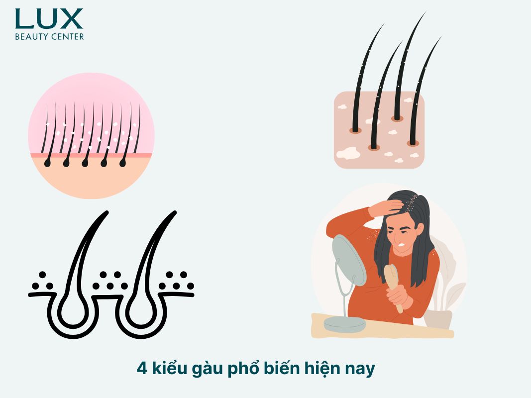 4 kiểu gàu phổ biến hiện nay 