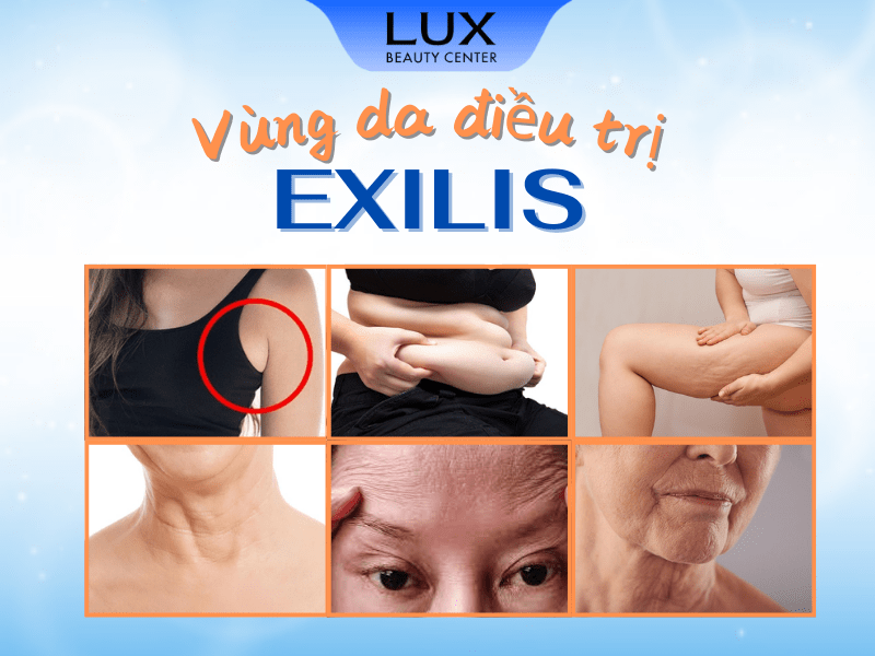 hình các vùng da trên cơ thể bị chảy sệ và chữ exilis skin tightening vs ultherapy