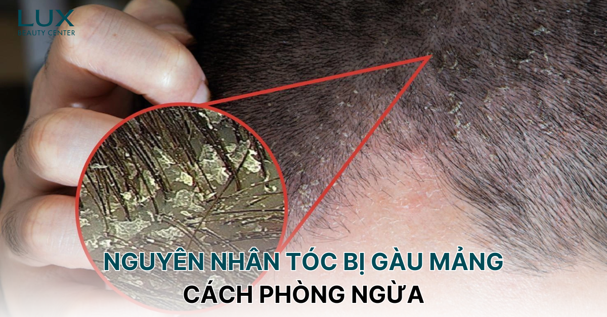 NGUYÊN NHÂN TÓC BỊ GÀU MẢNG VÀ CÁCH PHÒNG NGỪA HIỆU QUẢ