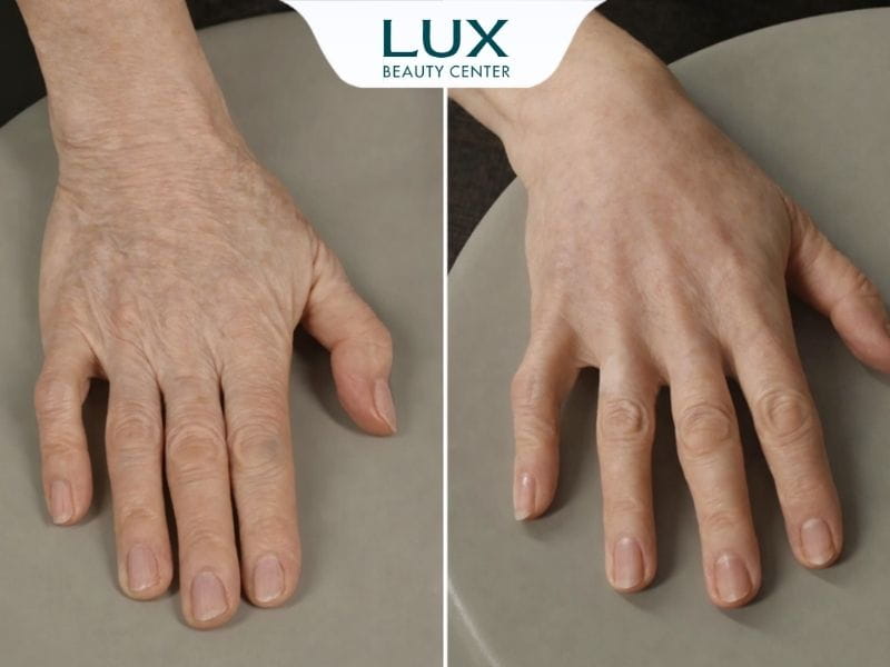 hình bàn tay trước và sau khi trẻ hóa