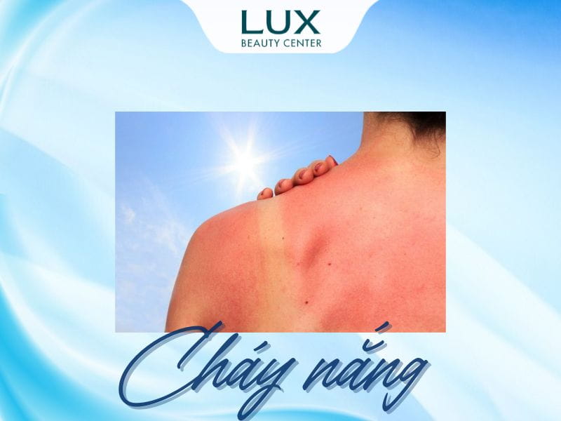 hình da bị cháy nắng và chữ