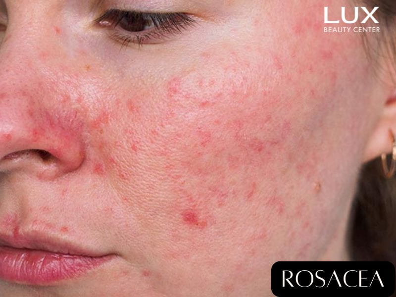 cô gái bị rosacea trên da và chữ