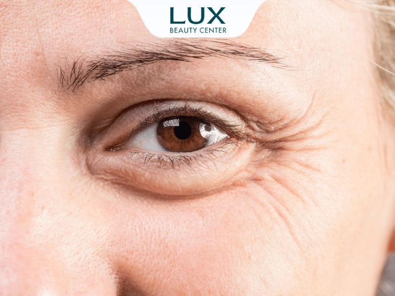 hình cô gái bị vết chân chim ở đuôi mắt