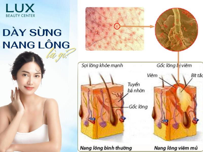 hình cô gái và da bị dày sừng nang lông và chữ