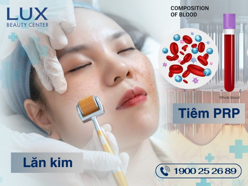 hình cô gái đang được lăn kim và tiêm prp