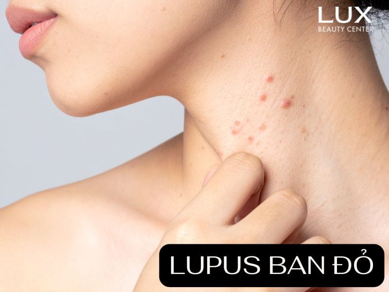 cô gái bị lupus ban đỏ