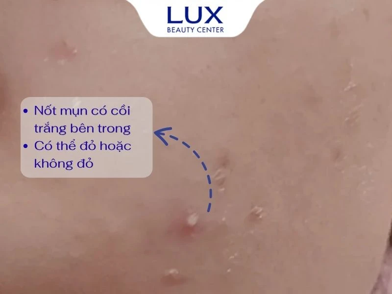 hình mụn đầu trắng và chữ dấu hiệu nhận biết mụn đầu trắng không viêm