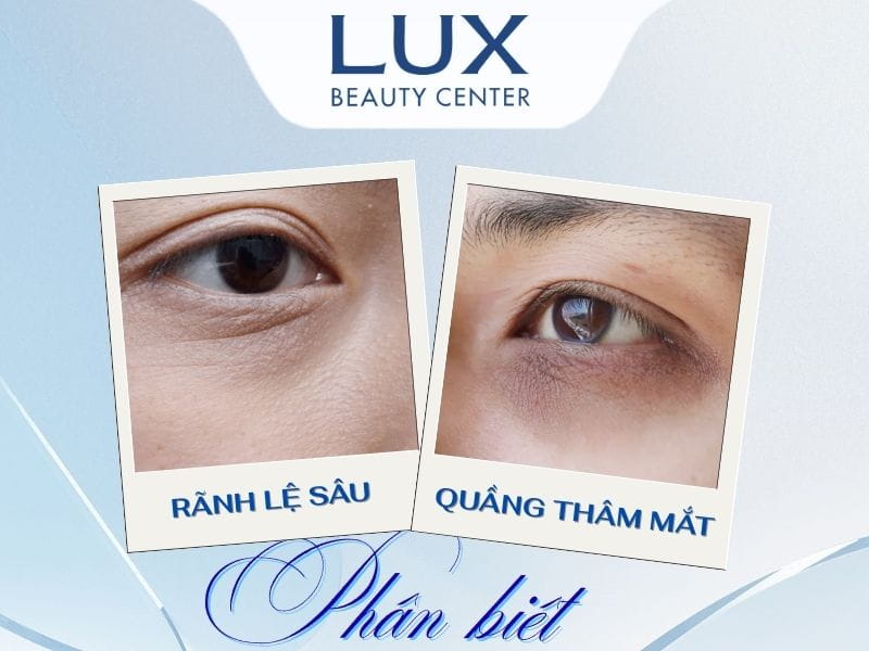 hình đôi mắt bị rãnh lệ và bị quầng thâm mắt và chữ