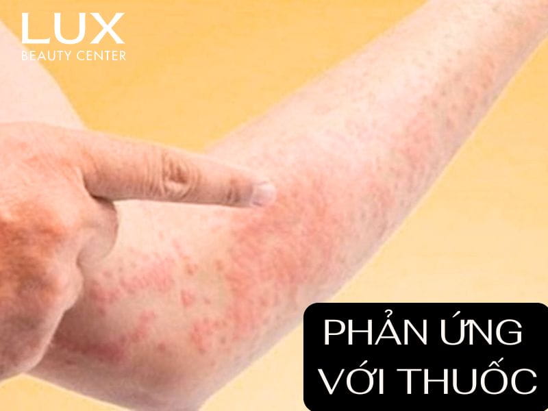 da tay bị kích ứng do thuốc