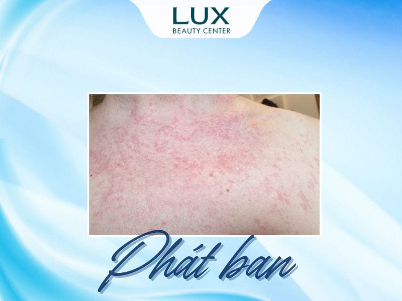 hình da bị phát ban và chữ