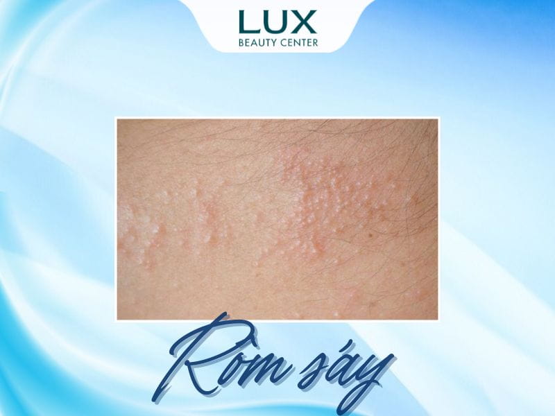 hình da bị rôm sảy và chữ