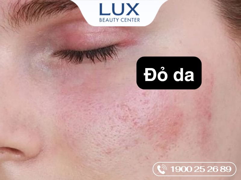 da bị rosacea đỏ và chữ