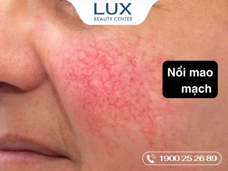 hình cô gái bị rosacea và chữ