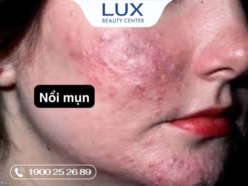 cô gái bị mụn rosacea và chữ