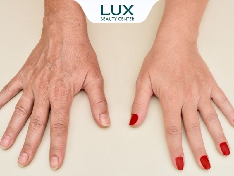 hình bàn tay trước và sau trẻ hóa bằng filler
