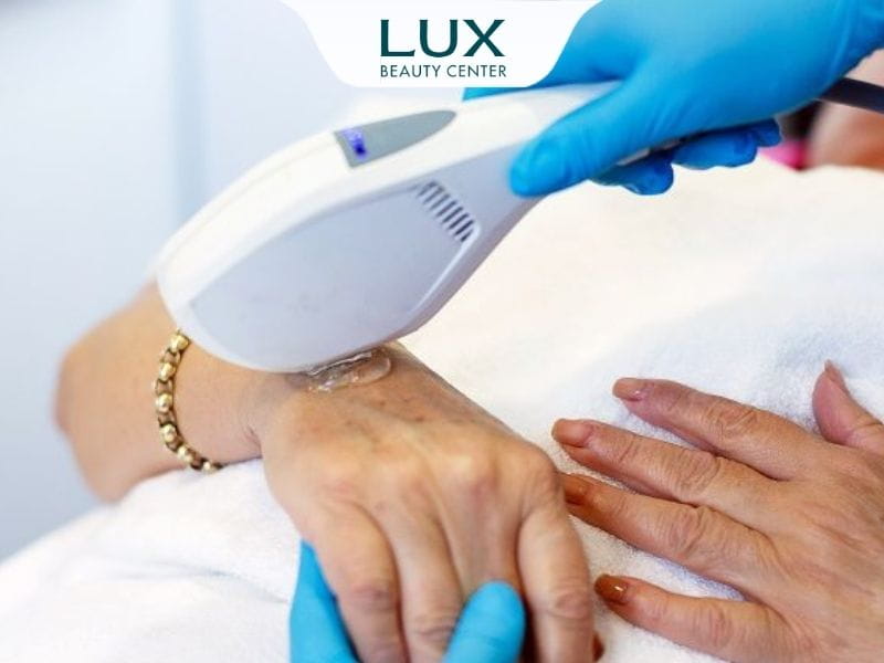 hình bàn tay cô gái đang được bắn laser điều trị các vấn đề về sắc tố da