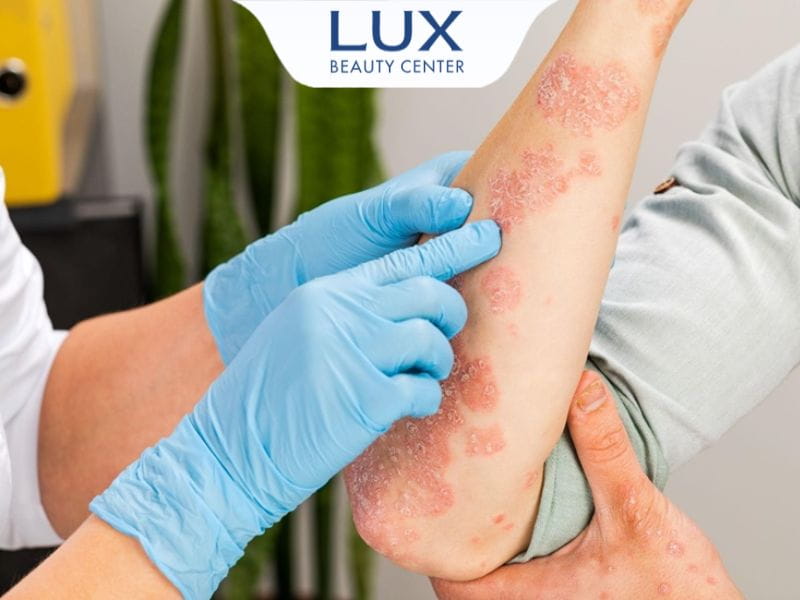 bác sĩ khám viêm da cơ địa tay bệnh nhân