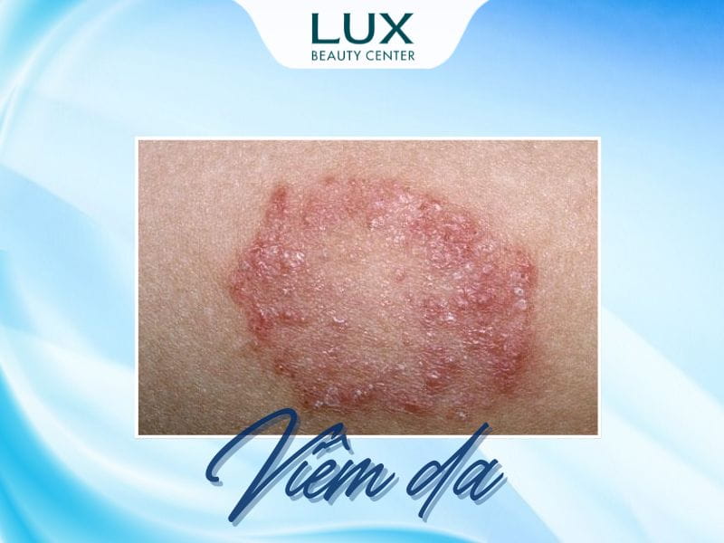 da bị viêm do ký sinh trùng và chữ