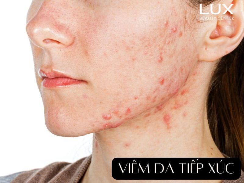 cô gái bị viêm da tiếp xúc