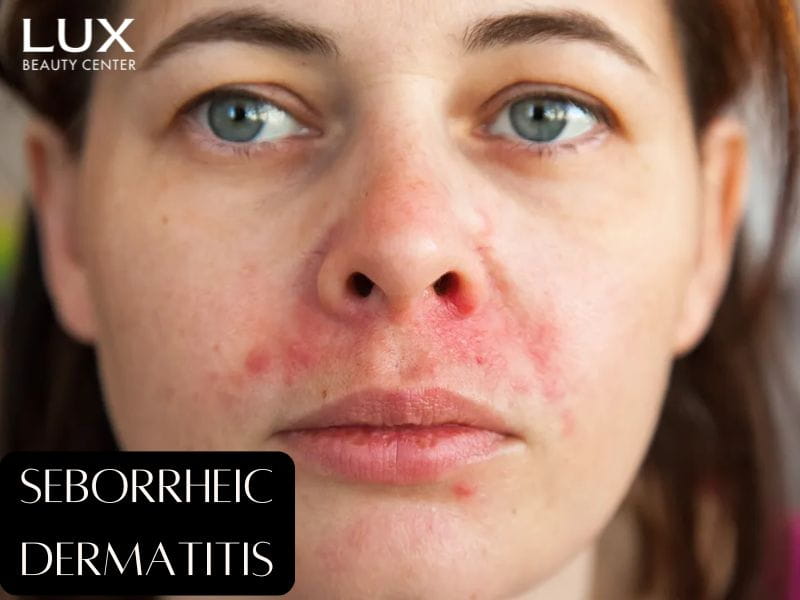 cô gái bị Seborrheic Dermatitis